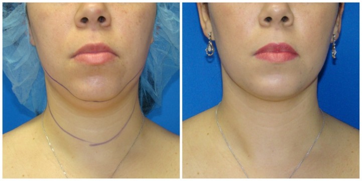 How is the liposuction procedure performed? b048-bd72-b0a8